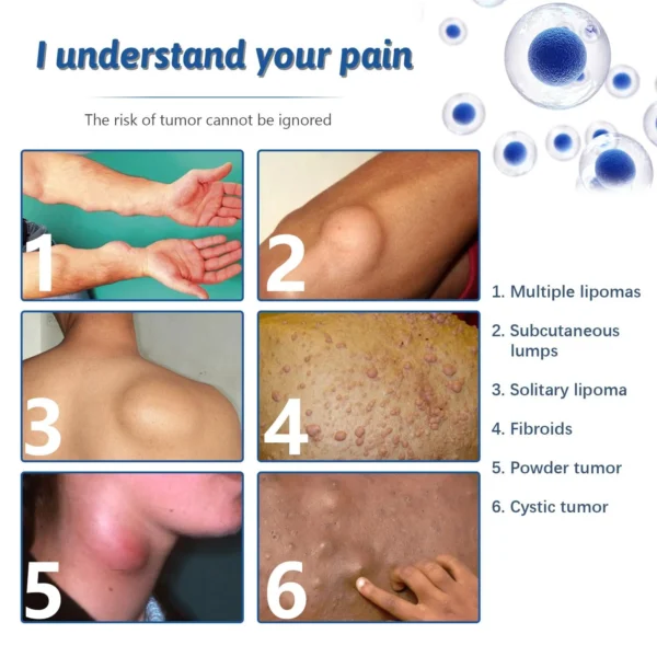 Lipomas Removal Spray Relief Pain Treat Skin Swelling 50ml Nodule Lipolysis Cellulite Removal Ointment Spray Lump Fat V5P6