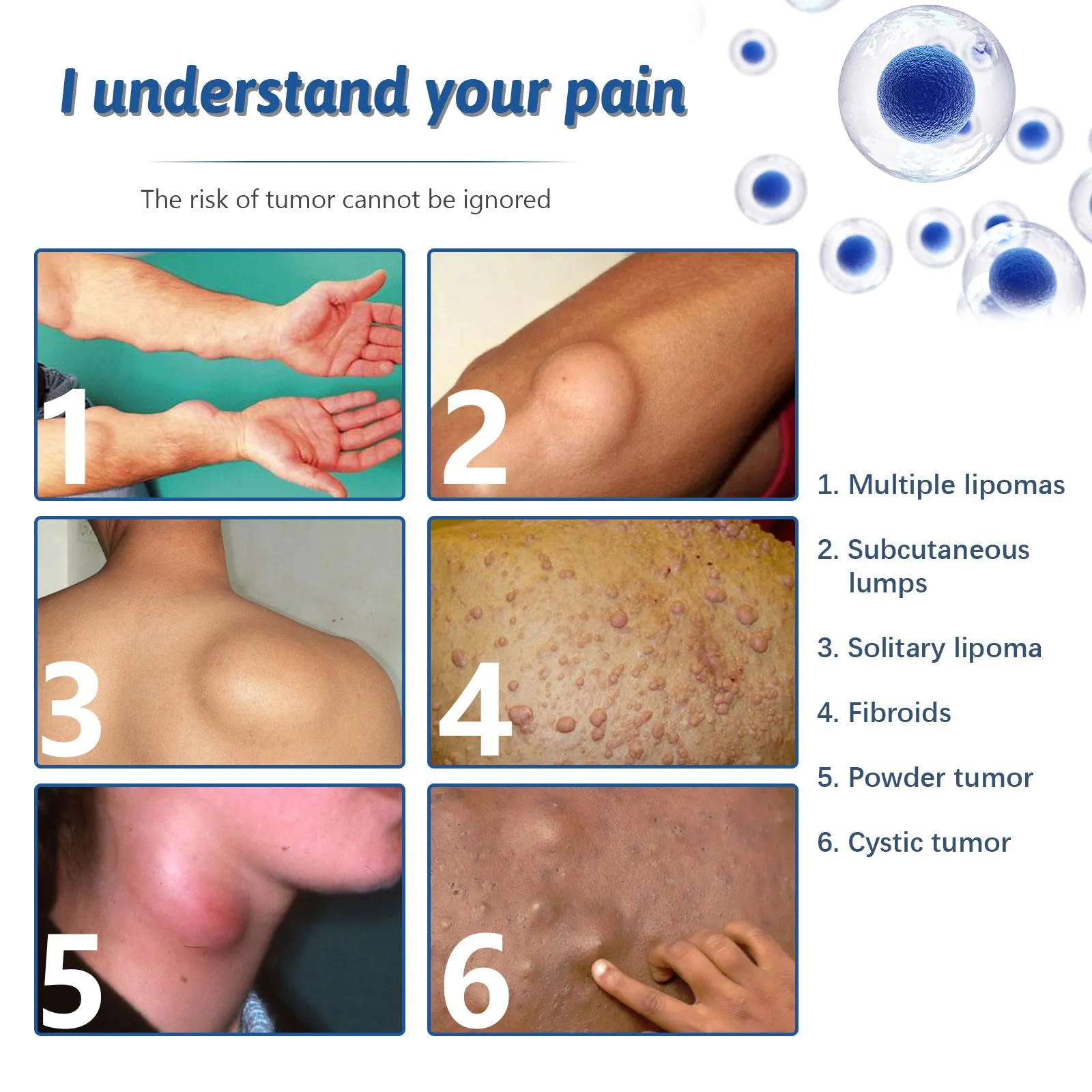Lipomas Removal Spray Relief Pain Treat Skin Swelling 50ml Nodule Lipolysis Cellulite Removal Ointment Spray Lump Fat V5P6