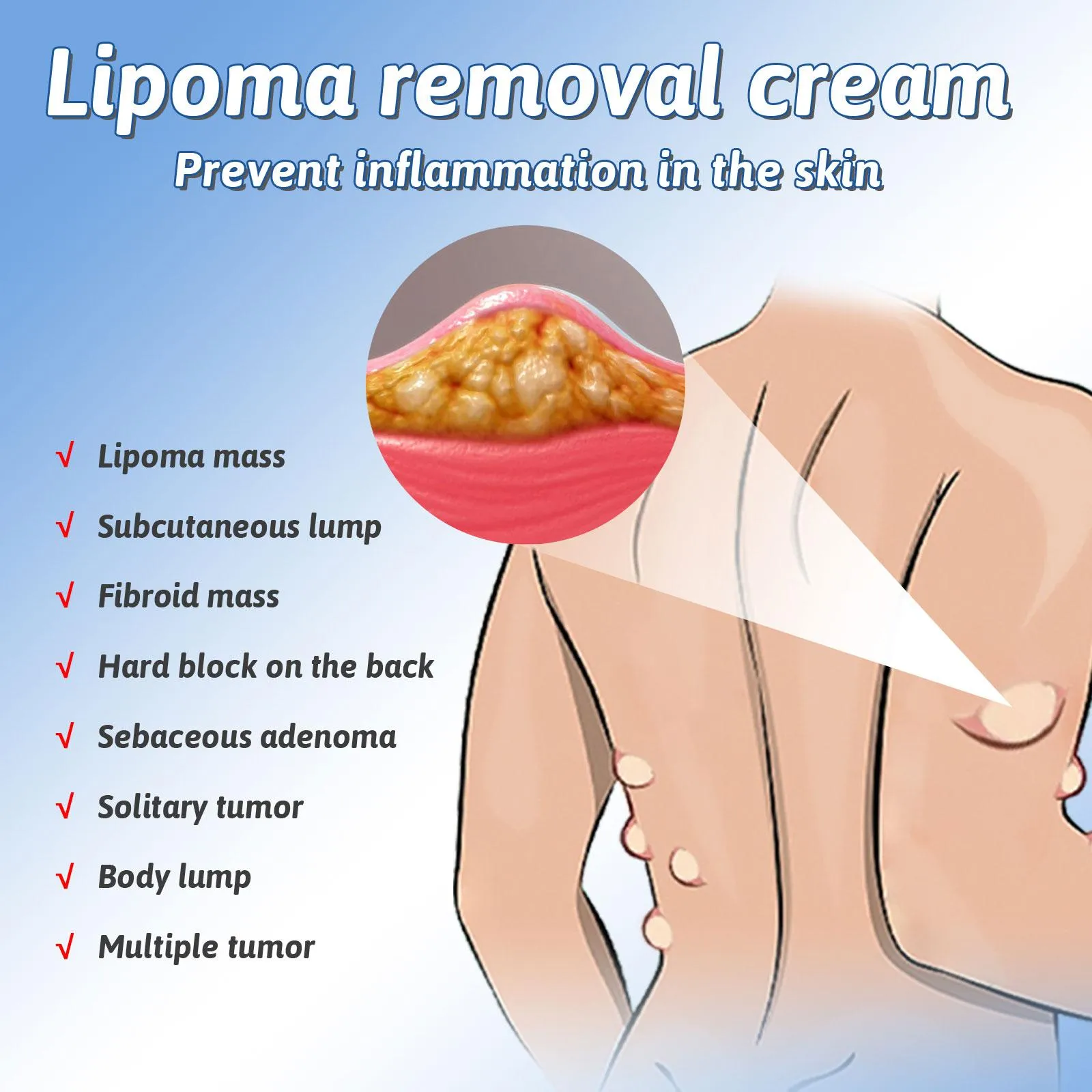 Lipomas Removal Spray Relief Pain Treat Skin Swelling 50ml Nodule Lipolysis Cellulite Removal Ointment Spray Lump Fat V5P6