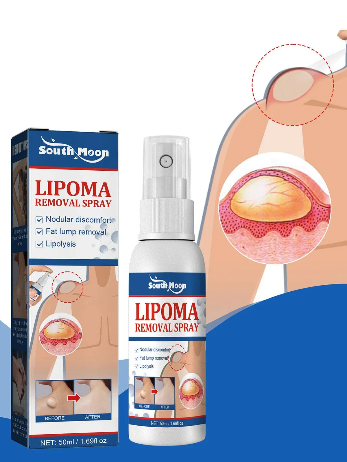Lipomas Removal Spray Relief Pain Treat Skin Swelling 50ml Nodule Lipolysis Cellulite Removal Ointment Spray Lump Fat V5P6